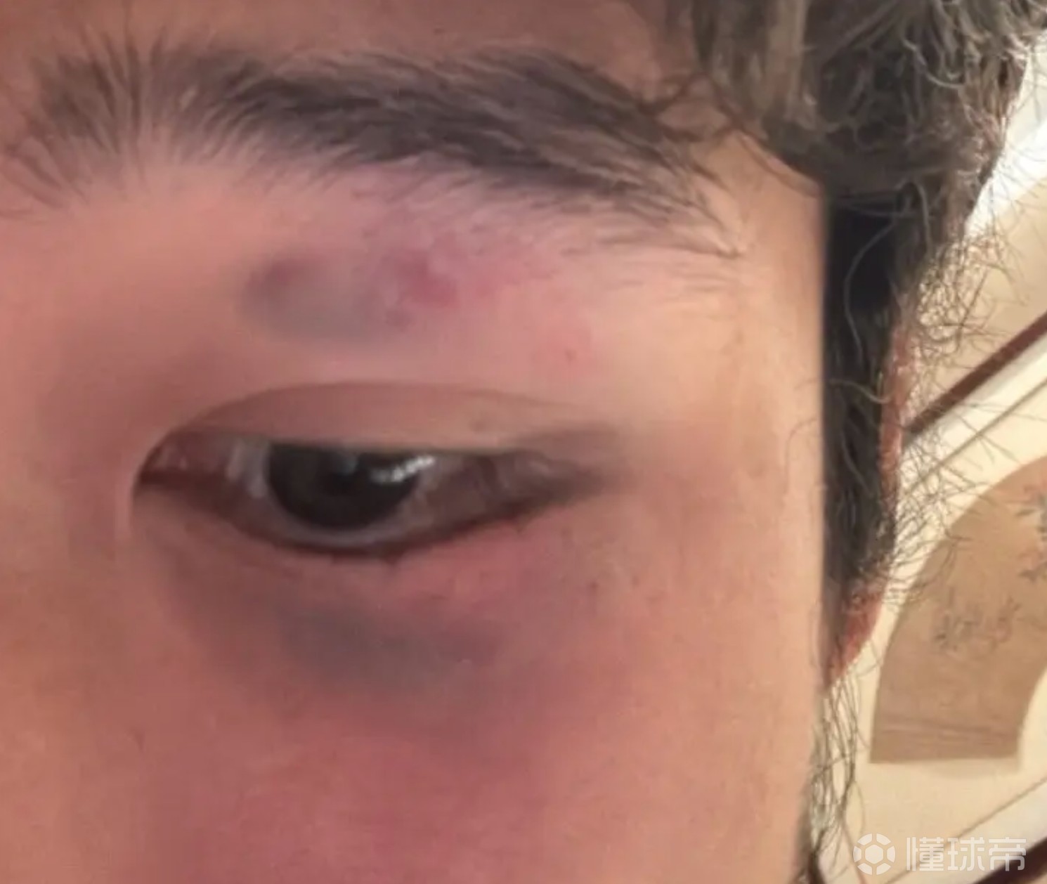 阮奇龙被击中面部：当时头晕呕吐，现在并无大碍